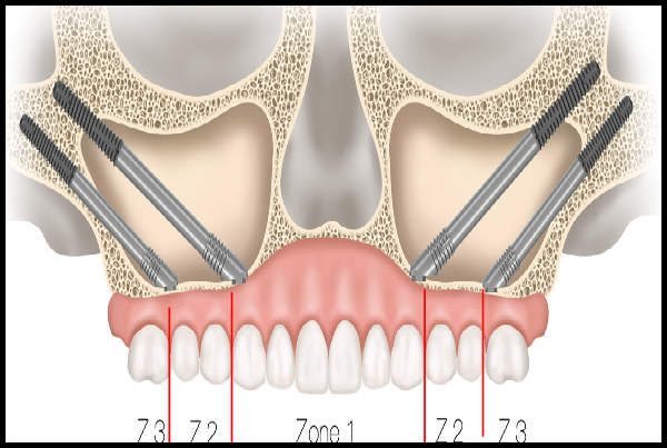 Zygomatic Implants