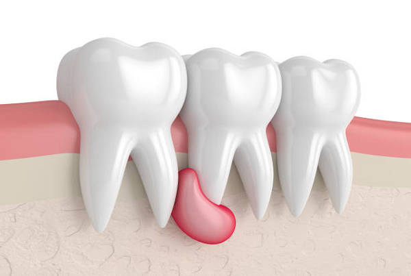 Oral Cyst and Tumors
