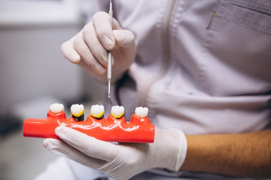 Dentist demonstrating a dental implant procedure using a tooth model at a dental implant clinic in Sector 90 Gurugram.